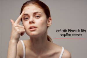एक्ने और पिंपल्स के लिए प्राकृतिक समाधान